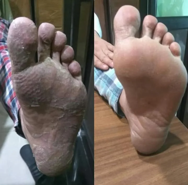 Before and after images of a patient’s feet treated with Padabhyangam therapy