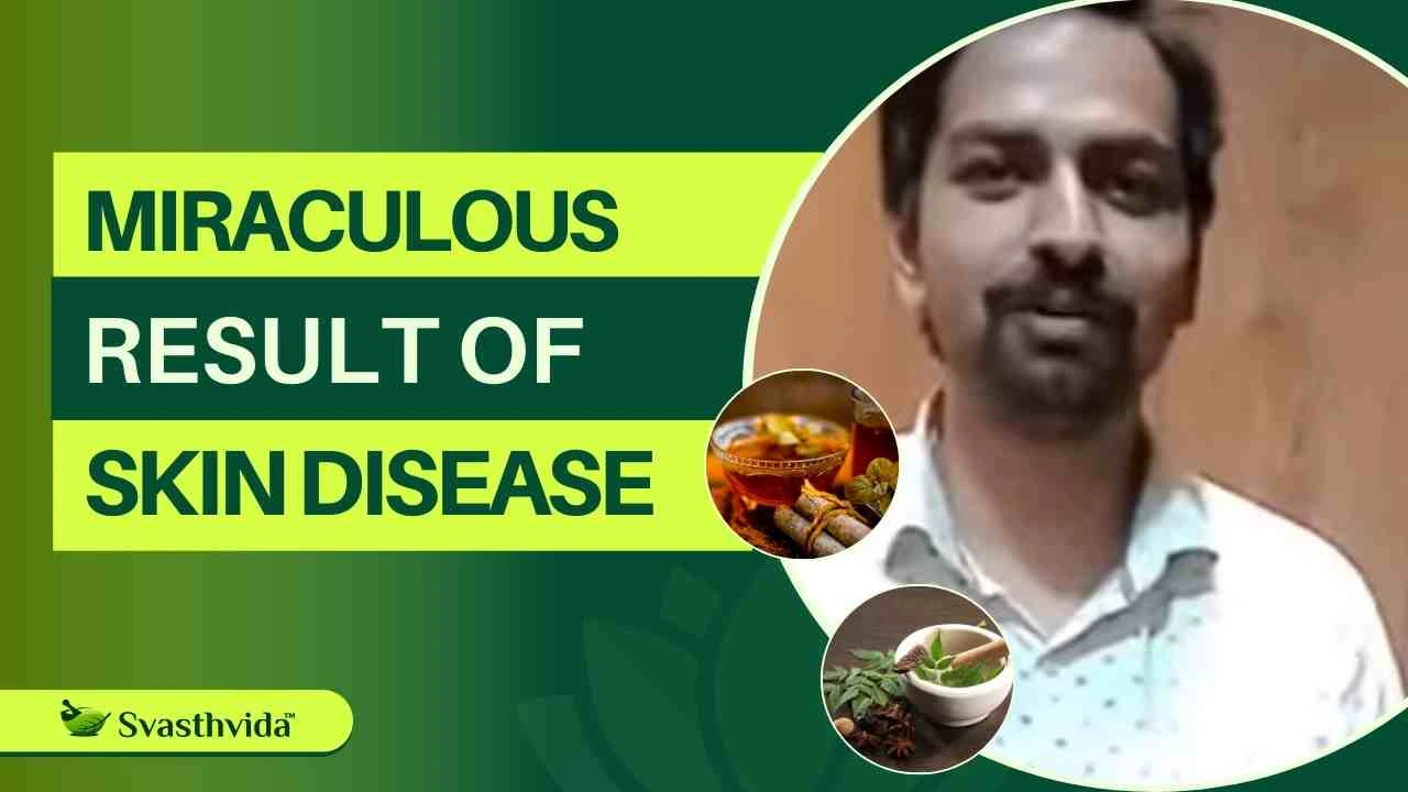 Miraculous Result of Ayurveda in Skin Disease | Svasthvida