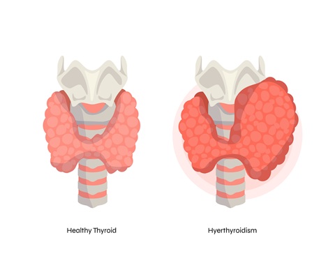 थायराइड (Thyroid) क्या है? लक्षण, कारण, प्रकार, आहार और आयुर्वेदिक देखभाल की पूरी जानकारी थायराइड