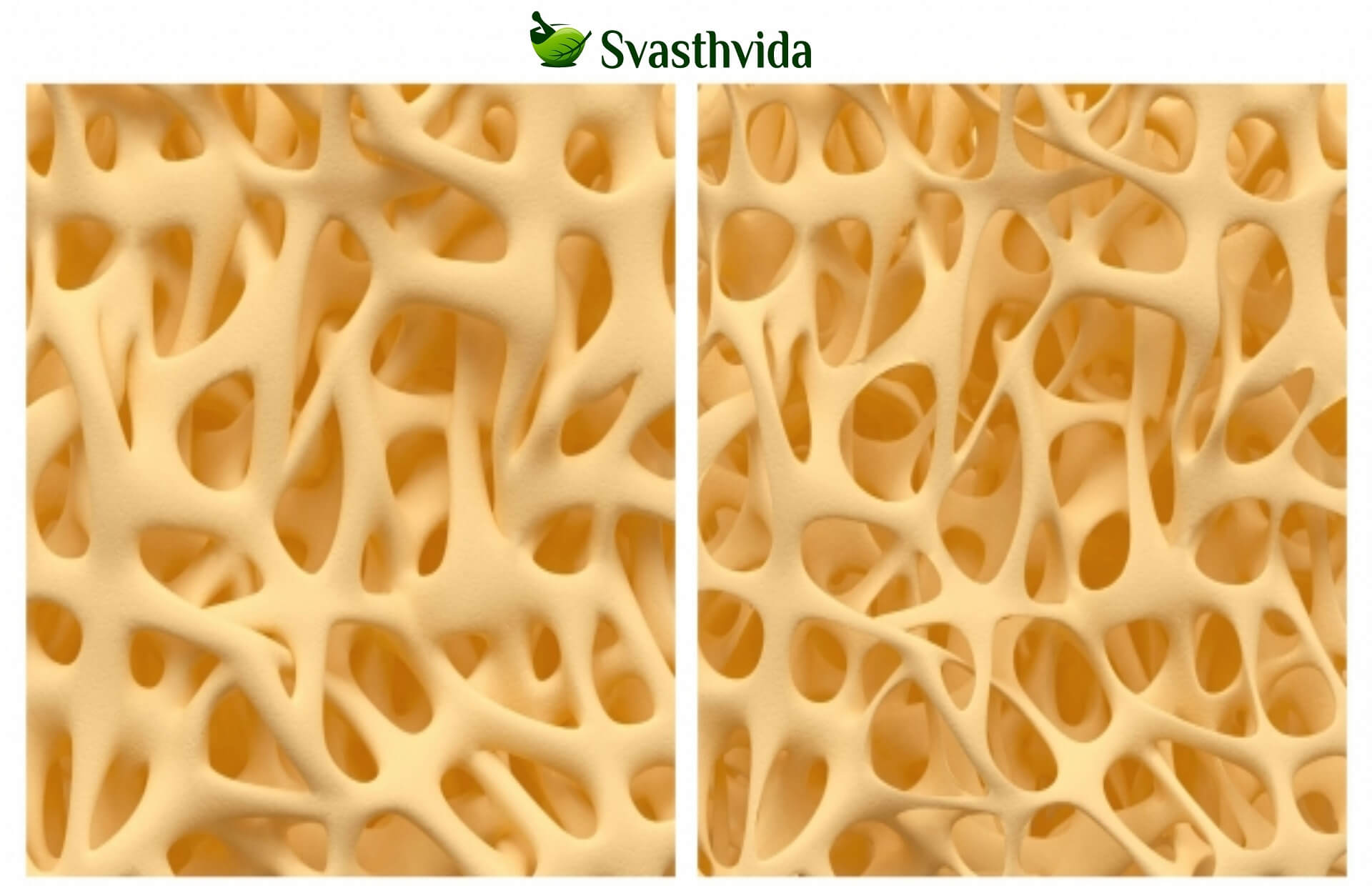 Ayurvedic Treatment For Osteoporosis In Achalpur