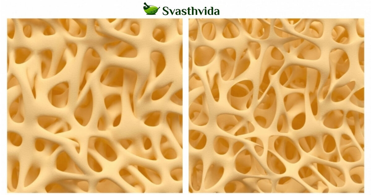 Ayurvedic Treatment For Osteoporosis