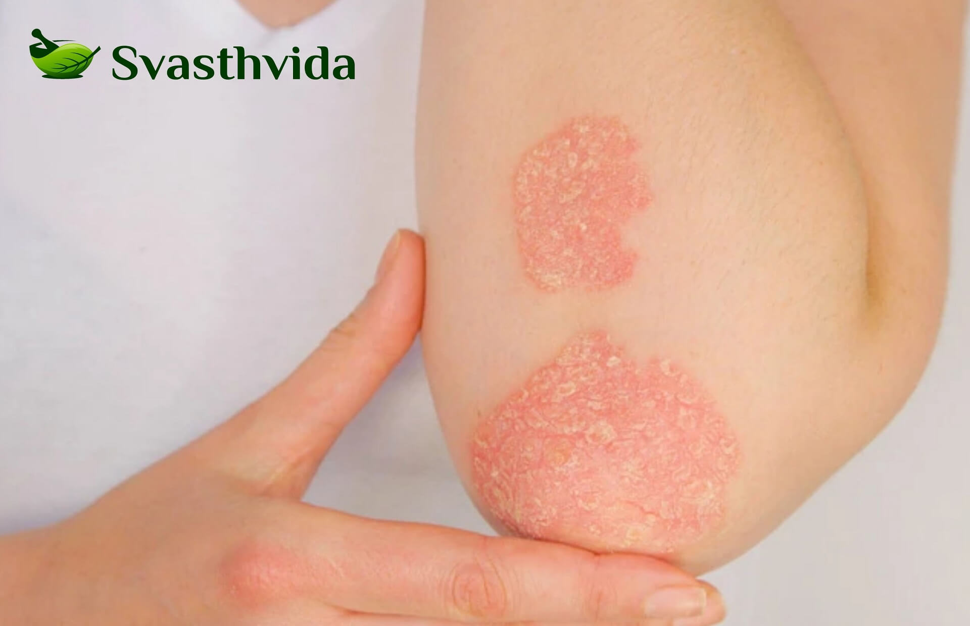 Ayurvedic Treatment For Psoriasis In Al-Rayyan