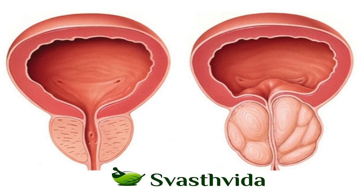 Ayurvedic Treatment For Enlarged Prostate
