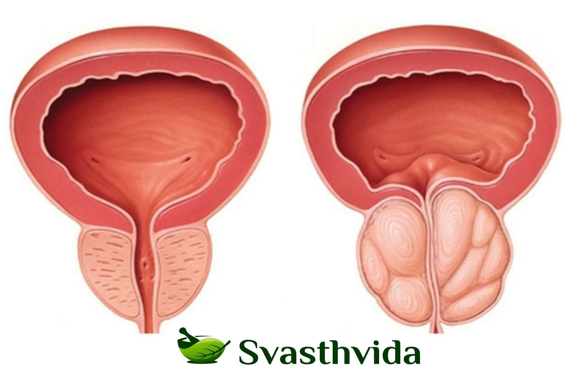 Ayurvedic Treatment For Enlarged Prostate In Amreli