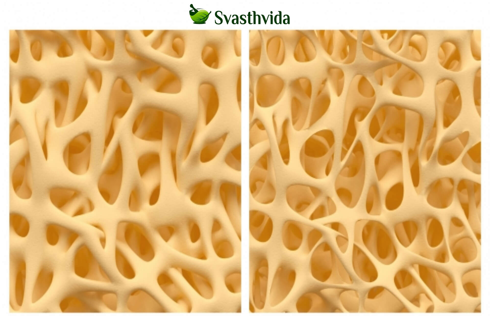 Ayurvedic Treatment For Osteoporosis In Ashokenagar-Kalyangarh