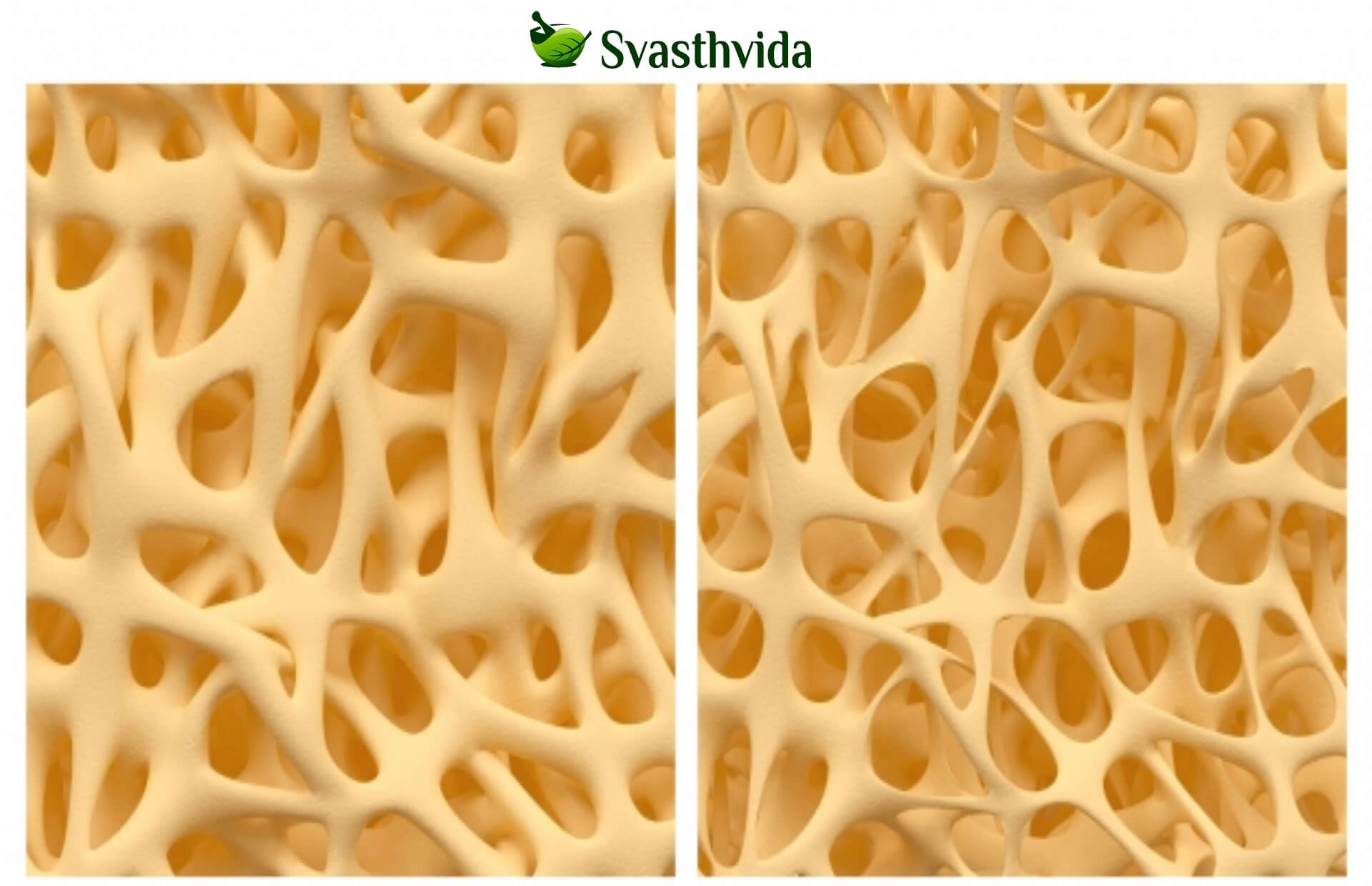 Ayurvedic Treatment For Osteoporosis In Guangzhou
