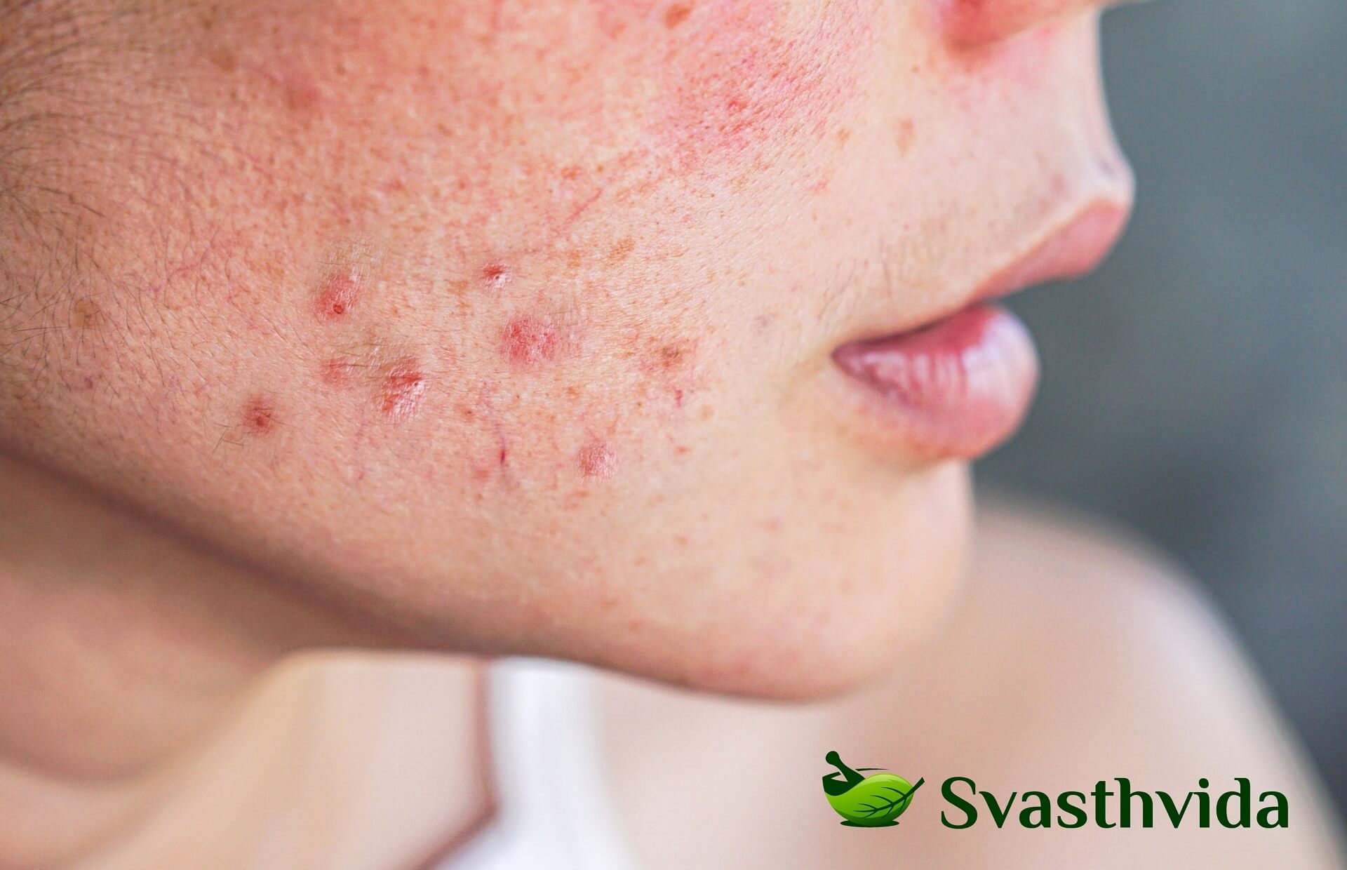 Ayurvedic Treatment For PCOD & PCOS In Guangzhou