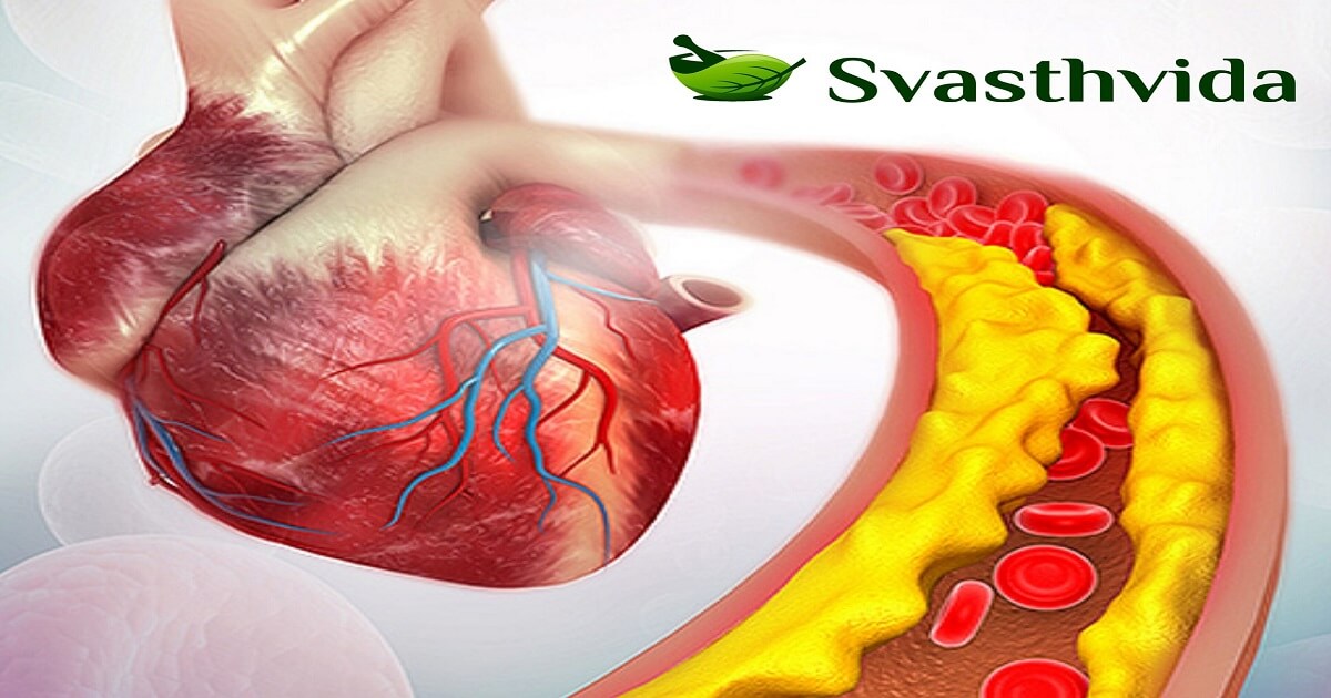 Ayurvedic Treatment For Atherosclerosis In Joga