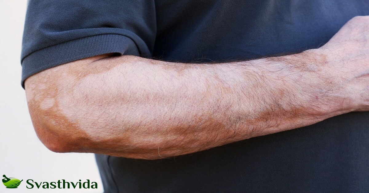 Ayurvedic Treatment For Leucoderma In Mecca