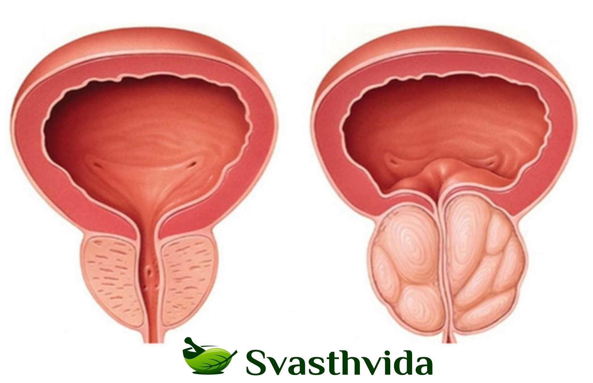Ayurvedic Treatment For Enlarged Prostate In Vanadzor